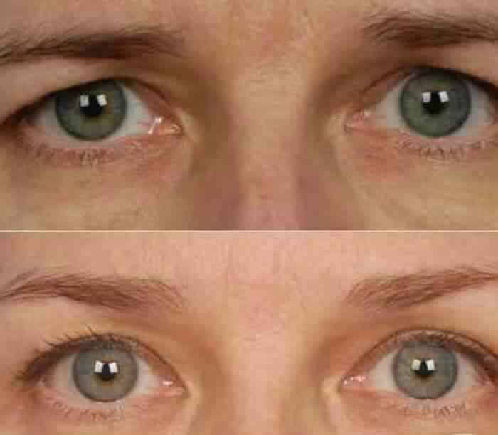 Botox for Brow Lift