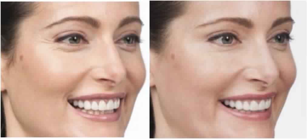 Botox for Crows Feet