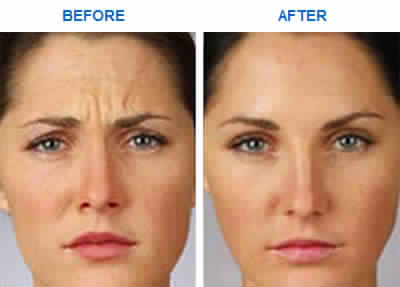 Botox for Forehead Lines