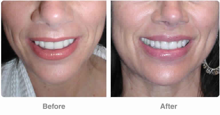 Botox for Gummy Smile