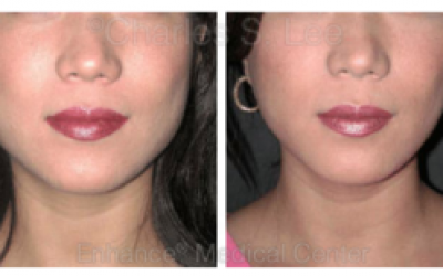 Cheek and Jawline Slimming