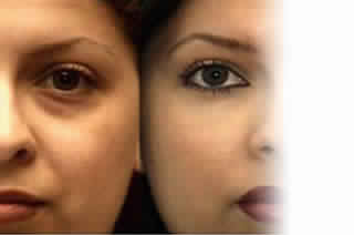 FAT GRAFTING TREATMENT
