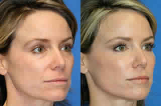 RF SKIN TIGHTENING