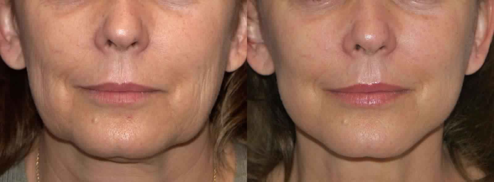 Nefertiti Lift for Neck Wrinkling and Sagging