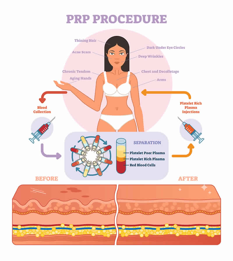 PRP for Face & Hair