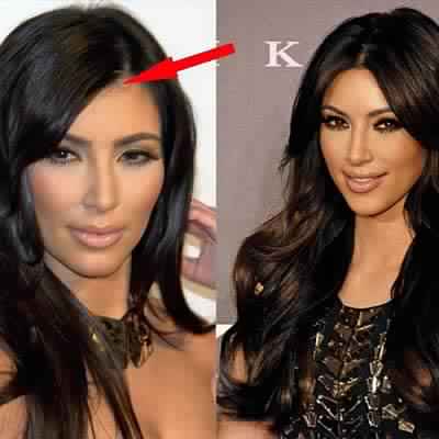 Baby come back? As Kim Kardashian says she regrets having her baby hairs lasered while Kylie Jenner shows hers off, experts weigh in on what you should do with yours